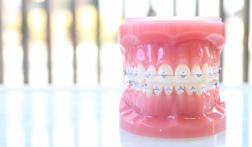 ブラケット矯正