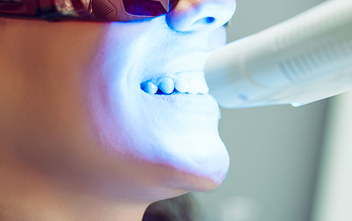 オフィスホワイトニング