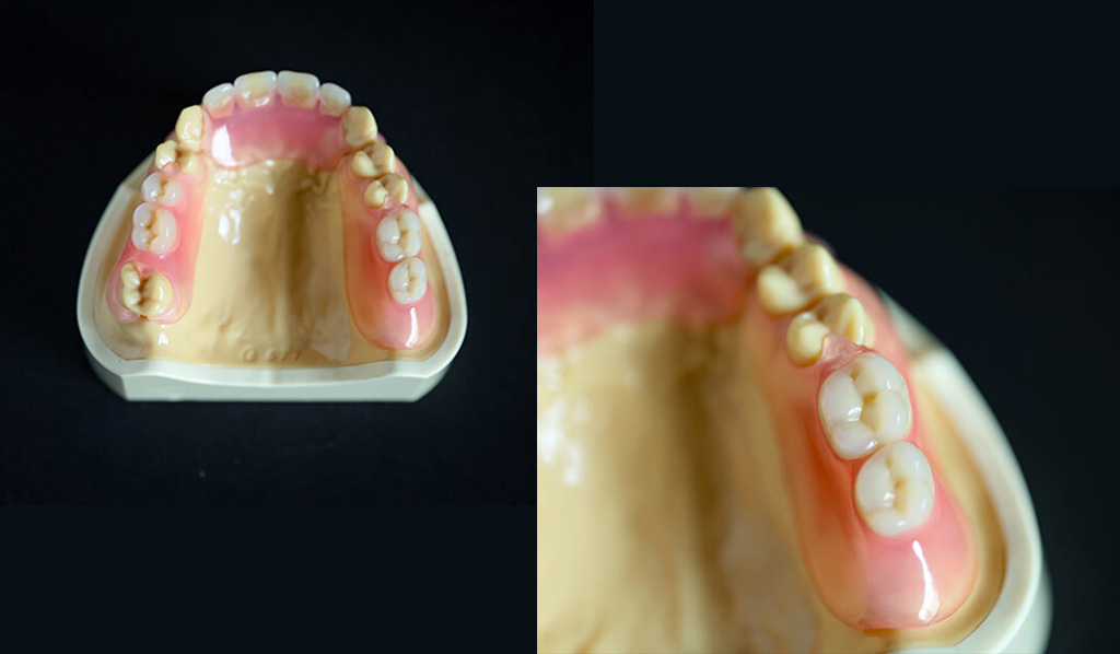 ノンクラスプ（当院がおすすめするエステショットブライト）