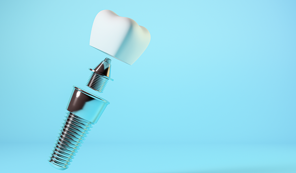 インプラントは、他の歯を守るための「支え」となります