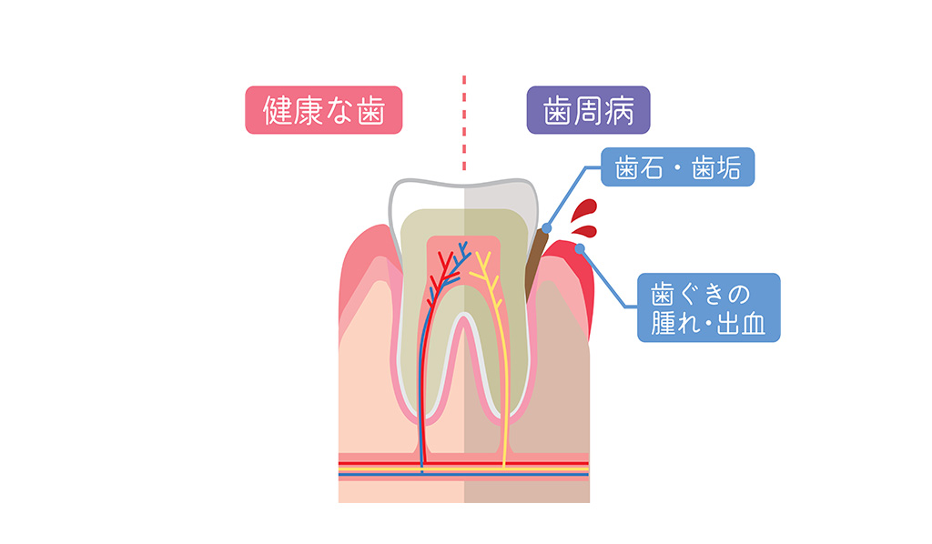 知らないうちに進行してしまう恐ろしいリスク