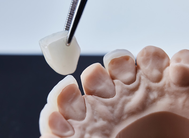 被せ物（補綴治療）で歯を守る